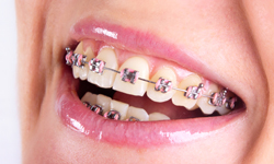 Affordable Metal Braces Services in Greater Boston Orthodontics