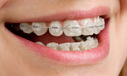 Get the Best Ceramic Braces Services in Greater Boston